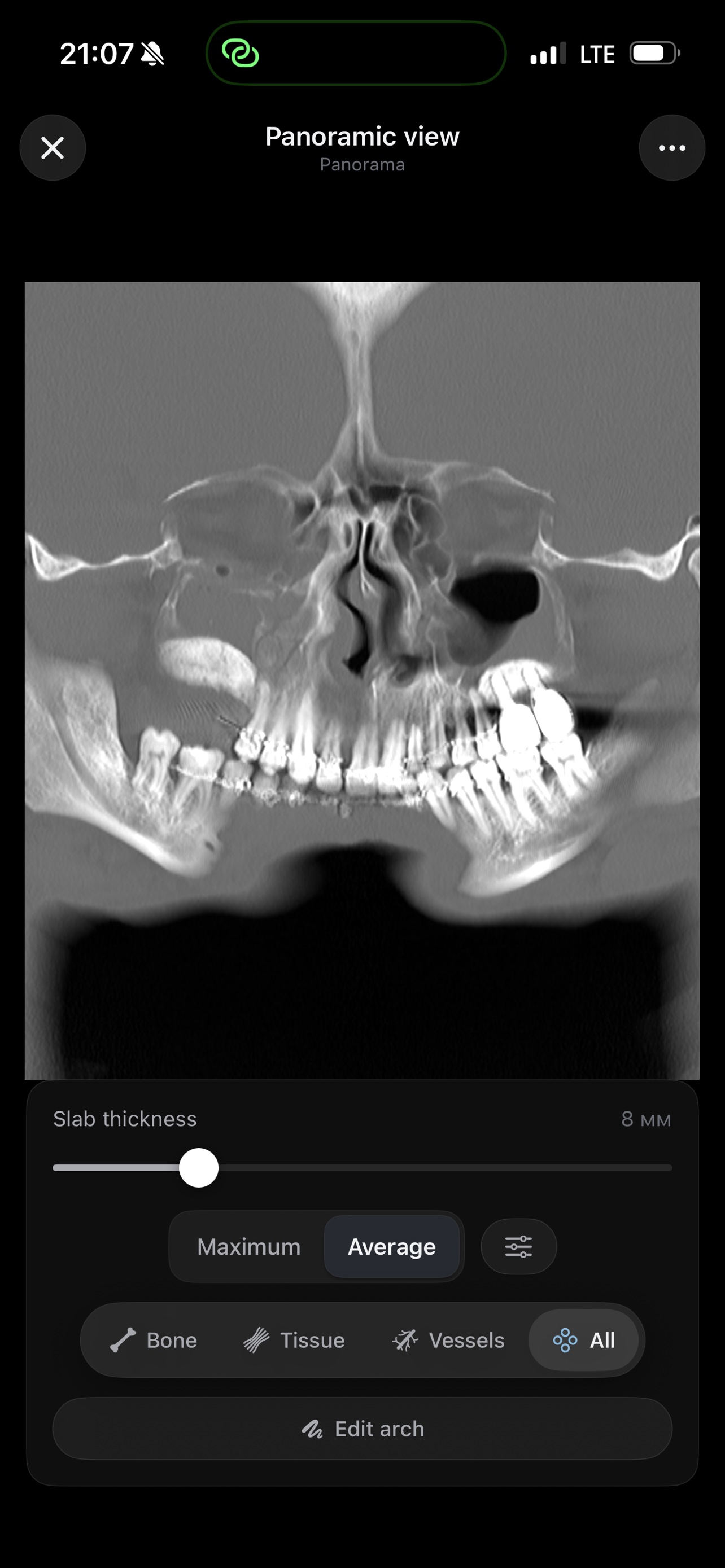 Panoramic dental view reconstructed from a 3D CT scan